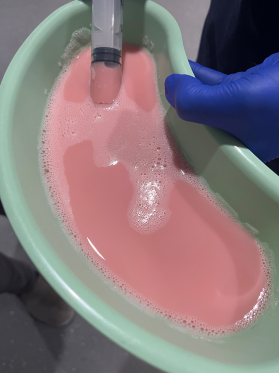 Pink fluid from thoracocentesis